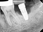 Fig 5. December 2013 radiograph taken at the time of laser treatment.