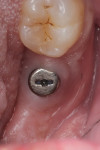 Fig 4. Two weeks after lesion debridement and placement of healing abutment.