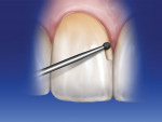 Figure 4  A 016 round bur is placed at the tipof the gingival papilla and cuts the cervical marginin a counterclockwise direction. The bur shaft isheld in contact with the facial aspect of the tooth.