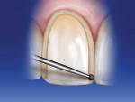 Figure 5  Using the 016 round bur, the gingivaland interproximal margins are placed at the correctdepth.