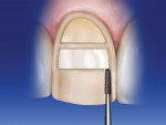 Figure 7  Using a 018 tapered diamond bur,the unprepared enamel islands are removed tothe level of the horizontal depth cuts. The reductionfollows the facial contour of the tooth.