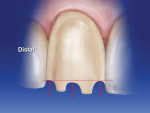 Figure 8  The arrows show the level of theincisal depth cuts. The distal depth cut is the mostgingivally positioned, followed by the mesial andthen the center depth cuts.