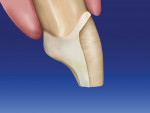 Figure 12  Lateral view of prepared tooth afterthe proximal contacts have been separated.