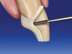 Figure 13  A tapered diamond bur is used toextend the proximal margin further to the lingualaspect of the prepared tooth.