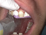 Polyvinyl siloxane index template in place with cured lingual and incisal composite.