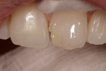 Figure 3  Composite placed to mimic dentin.