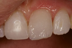 Figure 4  Enamel mimicking composite placedto match the translucency of the adjacent teeth.