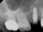 Postoperative radiograph demonstrating excellent implant positioning.