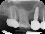 Postoperative radiograph of tooth No. 4.
