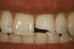 Figure 6  Minimal preparation of a severelyfractured maxillary central incisor.