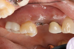 Preoperative view of non-restorable root tooth No. 4.