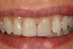 Figure 14  The final polychromatic revitalization,2 weeks after treatment.