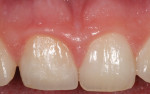 Fig 9. The clinical appearance
of the definitive ceramic crown shown at 1 year post treatment. Note the position and contour of the free gingival margins and absence of clinical inflammation.