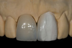 Fig 11. Replacement of existing crown along with a porcelain-bonded proximal restoration placed on adjacent central incisor corrected the width discrepancy
and the proximal embrasure space.