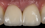 Fig 17. The initial
appearance of the patient’s maxillary right implant-supported and left natural tooth crowns. Note the
deficiencies of the restorative contour and soft-tissue profile.