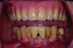 Fig 1 and Fig 2. The patient presents with a failing mandibular dentition
and a maxillary complete denture.