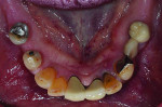 Fig 1 and Fig 2. The patient presents with a failing mandibular dentition
and a maxillary complete denture.