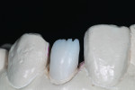 Fig 3. The crowns were passed with the IPS e.max MO-0 ingot due to the dark gingival shade of tooth No. 7