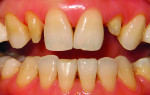The clinician prepared teeth Nos. 7 and 10 for crowns. Note that stump shades on teeth Nos. 7 and 10 are relatively clean but the stump shade of tooth No. 7 is somewhat darker.
