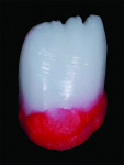 Fig 4. A porcelain margin was incorporated to prevent the brighter ingot shade from showing through on the darker gingival of tooth No. 7.