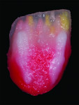 Fig 12. Mesial and distal line angles were high lighted using bright enamel OE4.