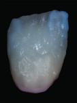Fig 19. An application of a mixture of one-third Dentin A2 and two-thirds of CT yellow-orange was applied in thin layers on the gingival one-third and a thin layer of T Blue was layered on the mesial and distal incisal aspects to further enhance the bluish translucency often found in natural dentition.