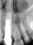 Figure 13  A radiograph confirmed proper placement of the abutment.