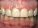 Figure 15  The final restoration 2 years after treatment.