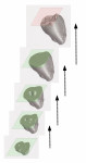 Graphic representation of 3D printing in stages; in this case, of a model tooth. Model tooth is printed in successive planer layers, and at any stage of printing, the root or crown may be stopped and selected as the final model.
