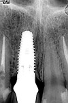 Figure 16  Radiograph of the implant 2 years postoperatively.