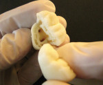 Different patterns of material layering can be
programmed into the printer to create special effects. Here, the void areas between the
external and internal tooth model surfaces allow for safer and easier sectioning to accurately
expose the interior pulp chamber. These voided areas may later be filled in with material such as acrylic or composite. Note that the bifurcation area is clearly visible.