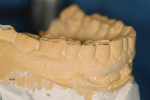 Right lateral view of proper curve of Spee, created by the Wynne 2000 occlusal plane analyzer.
