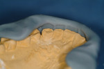 A comparison of the existing restorations to the patient’s pretreatment model indicated how much longer and wider the new veneers were compared to the original teeth.