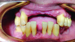 The patient had 16 teeth remaining between the two arches.