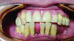 The patient’s existing maxillary partial denture.