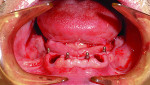 Additional extractions were performed 6 months after implant placement.