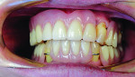 Maxillary and mandibular removable partial dentures were placed.