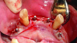 The mini dental implants in their final position.