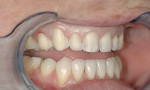 Figure 5  Right lateral view of the preparations.Note that minimal incisal reduction was necessarybecause the incisal length would be increased.