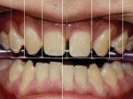 The existing tooth positions could be accommodated with minimally invasive
preparations if the dental midline was shifted 2 mm to the left (as indicated by green line).