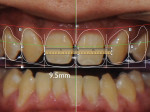 Photograph showing that the new width of
the central incisors will be 9.5 mm.