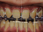 Photograph showing the changes proposed to
the length of tooth No. 8 (lengthen 1.5 mm), No. 9 (lengthen 1 mm), and No. 10 (shorten 1 mm).