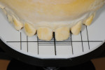The 9.5-mm incisor width index tray was selected.