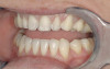 Percussion testing on tooth No. 19 performed by tapping the buccal tooth surface with the opposite end of a dental mirror.