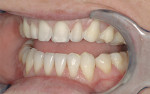Figure 6  Left lateral view of the preparations.Again, minimal incisal reduction was necessarybecause the incisal length would be increased.