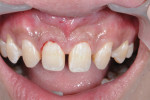 Periodontal surgery completed via laser treatment.
