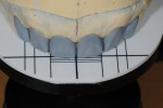 The technician was able to efficiently fabricate the wax-up by using the proportion guide.