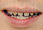 Close-up view with the interdental ruler in
place showing the position of tooth No. 8 in the facial midline,