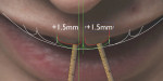 The 12 o’clock view photograph, taken from the top of the face, provided a view of the upper incisor position, which is recommended to be at the wet border of the lower lip. In
this case the central incisor edge will be moved labially 1.5 mm.