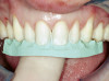 Palpation testing on tooth No. 19 performed by pressing index finger around the buccal and lingual gingiva.